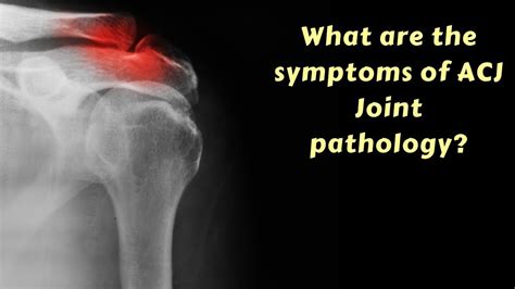 What are the symptoms of ACJ joint pathology? - YouTube