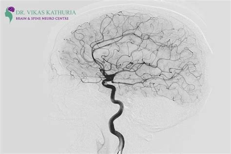 Cerebral Angiogram for Brain Aneurysm