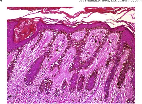 Acral Lentiginous Melanoma Histology