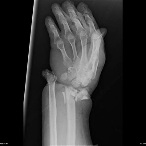 WRIST DISLOCATION | Buyxraysonline