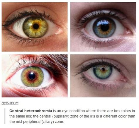 Eye color facts, Eye color, Heterochromia