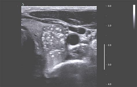 VIETNAMESE MEDIC ULTRASOUND: CASE 338: THYROID CANCER, Dr PHAN THANH ...