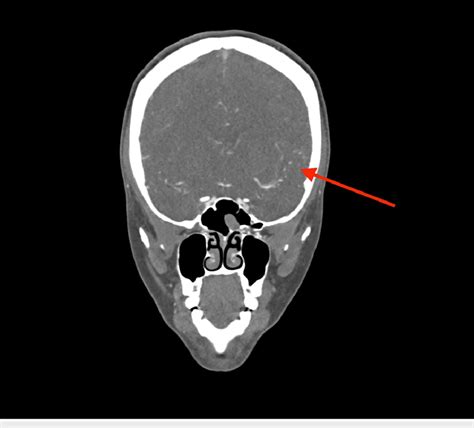 CT angiogram of the head and neck showing mild contour irregularity ...