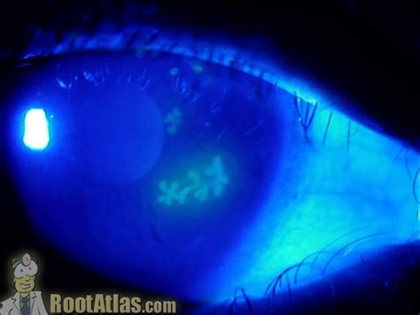 HSV herpetic dendritic ulcer on cornea (Video) - TimRoot.com