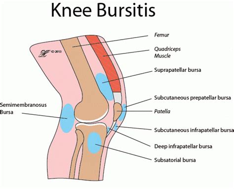 Knee Bursitis - Mississauga Chiropractor and Physiotherapy Clinic ...