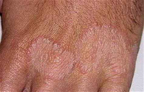 Hand Fungus – Symptoms, Causes, Pictures and Treatment : Health Blog