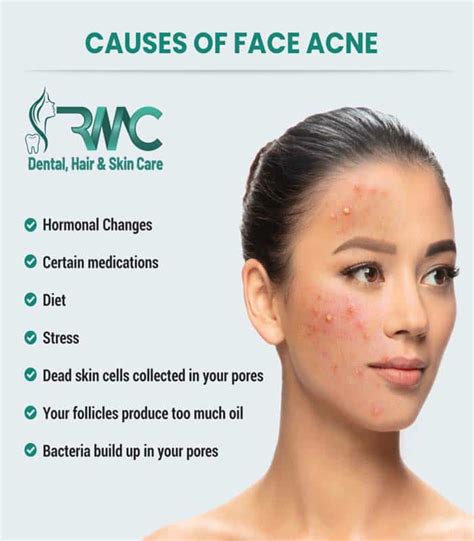 Acne Scars: Types, Causes and Treatment in Islamabad