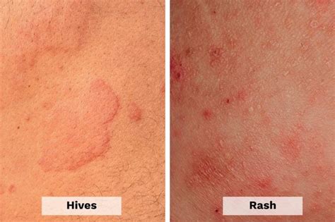 Hives vs. Rash: Here's How to Tell the Difference | The Healthy