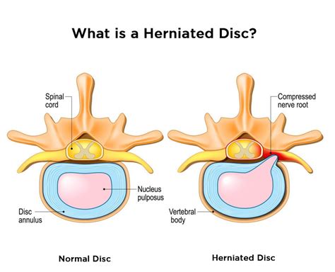 8 Tips to Avoid a Herniated Disc: Minimizing the Risks - Spine and Pain ...