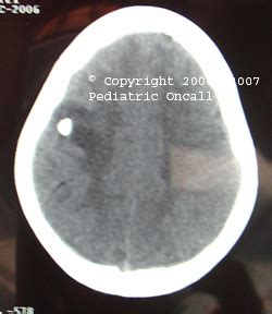 Calcified Granuloma | Spot Diagnosis | Pediatric Oncall