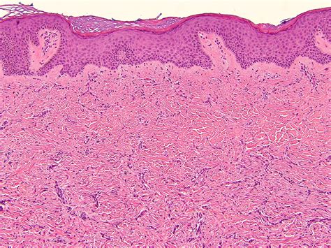 Dermatofibroma Histology