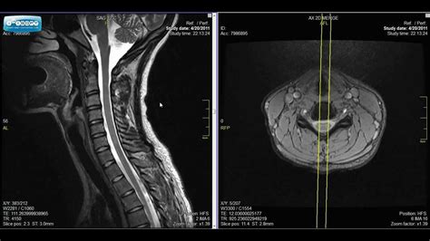 Mri Of The Cervical Spine Anatomy | The Best Porn Website