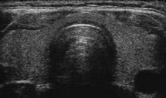 Thyroid Ultrasound