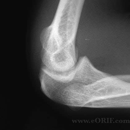 Congenital Radial Head Dislocation Q68.8 | eORIF