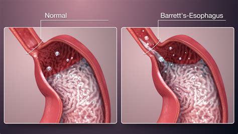 A Guide To Barretts Esophagus Symptoms Causes Treatments | Hot Sex Picture