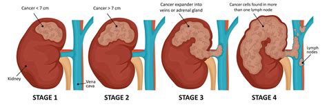 stages of kidney cancer - Public Health Notes