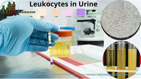 Leukocytes In Urine: What Does Leukocyte Esterase In Urine, 47% OFF