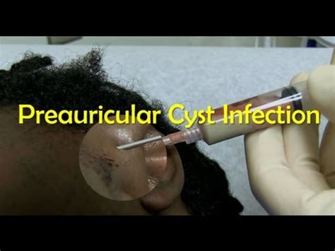 Preauricular Cyst Infection Management - BeHealthy