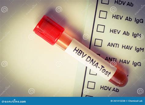 HBV DNA Test Test To Look for Abnormalities from Blood Stock Photo ...