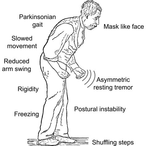 Parkinson Disease Treatment