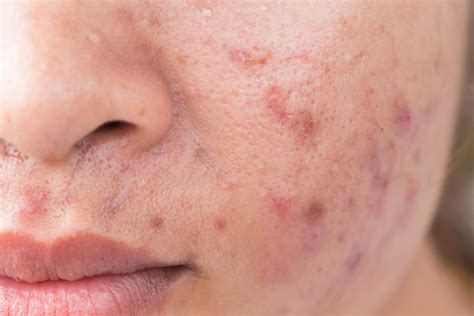 Acne Scars | Dermatology and Laser Centre of Los Angeles