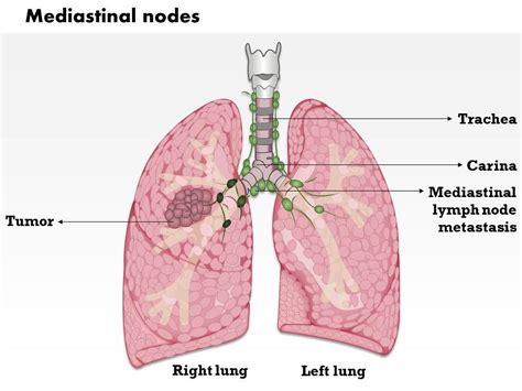 Hilar Lymph Nodes Lung Cancer