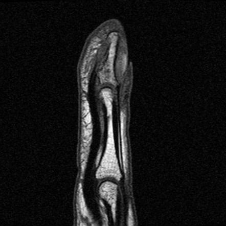 Juxta-cortical chondroma | Image | Radiopaedia.org