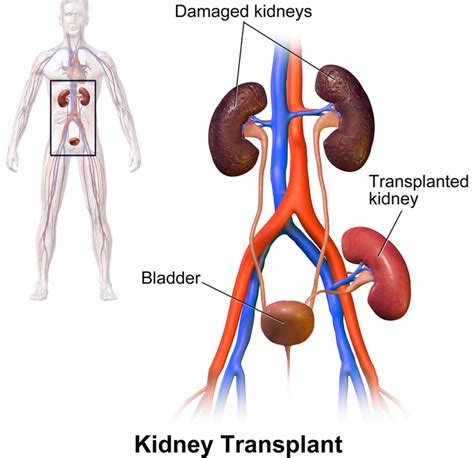 Kidney transplant process, procedure, cost, complications and recovery