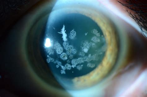 Corneal dystrophy | Wills Eye Hospital