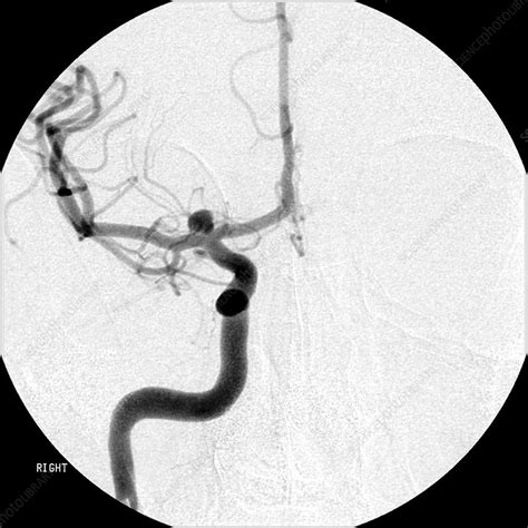 Cerebral Angiogram of Aneurysm - Stock Image - C027/0872 - Science ...