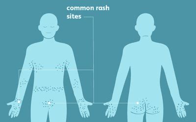 How Scabies Is Treated