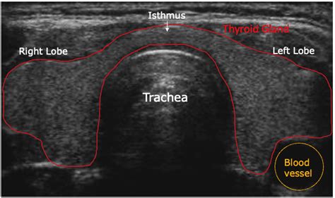 Normal Thyroid Ultrasound