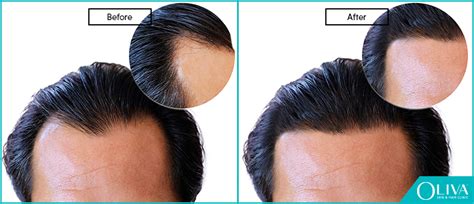 Receding Hairline: Causes, Treatments And Prevention