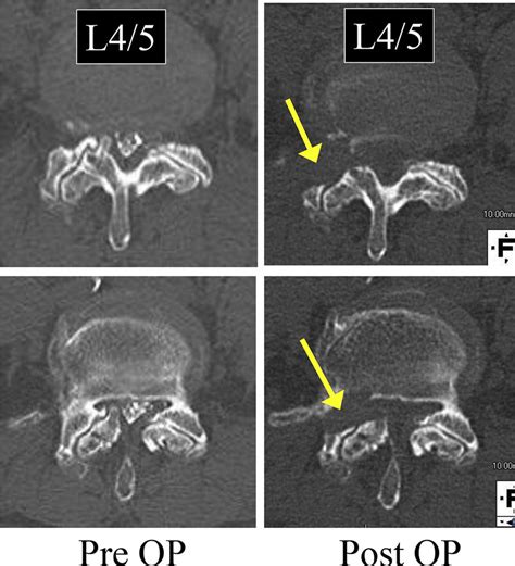 CT scans taken before and after the surgery of PEVF. Note the ventral ...