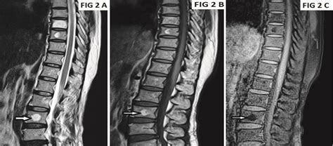 Hemangioma Mri