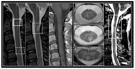 Cervical Spine Mri Ms