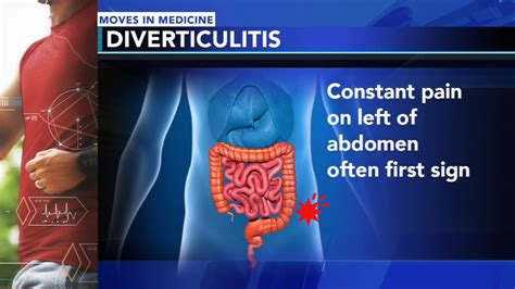 What Is Diverticulitis Symptoms Causes Treatment And Prevention | Porn ...