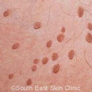 Skin Tags - South East Skin Clinic