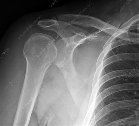 Dislocated shoulder, X-ray - Stock Image - C039/3327 - Science Photo ...