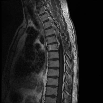 Vertebral Hemangioma