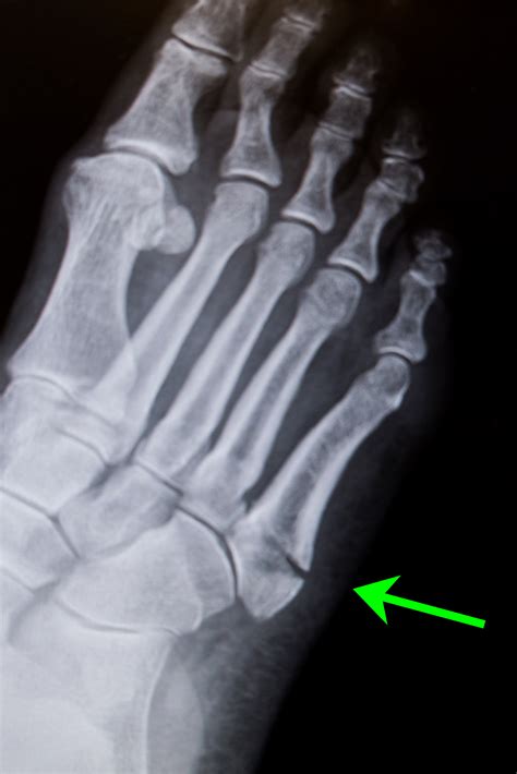 Metatarsal Fracture Foot - Friendly Foot Care PC