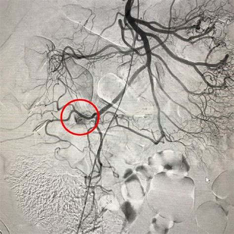 (A) First site of intestinal angiodysplasia, (B) second site of ...