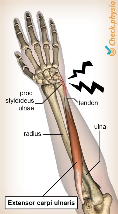 Extensor carpi ulnaris tendinopathy | Physio Check