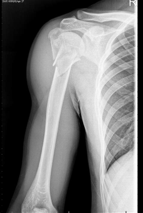 Proximal Humerus Fractures - Trauma - Orthobullets.com