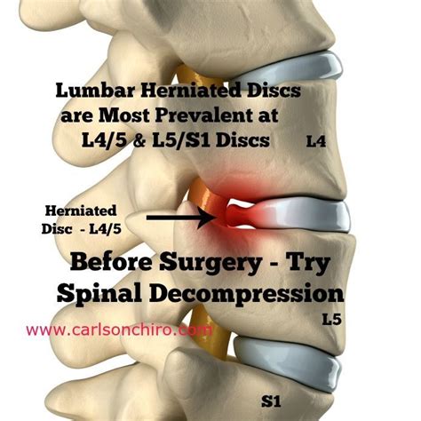 Lower Back Pain Herniated Disc Treatment