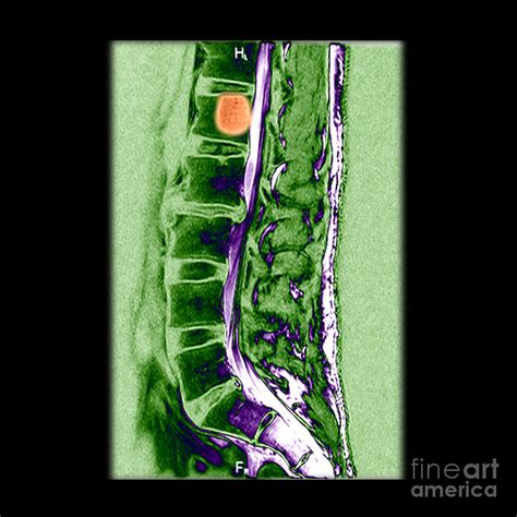 Mri Of Vertebral Hemangioma Photograph by Living Art Enterprises - Fine ...