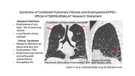 Snippet 12: Visual Classification of Centrilobular and Paraseptal Emphysema