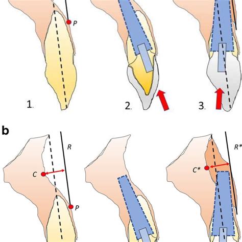 Cologne Classification of Alveolar Ridge Defects (CCARD) differentiates ...