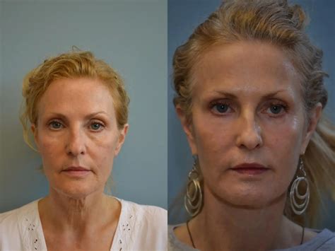 Plastic Surgery Before and After Pictures | Providence Facial Plastic ...