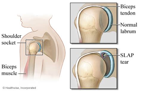 Slap Tear | Brisbane Knee and Shoulder Clinic | Dr MacgroartyBrisbane ...